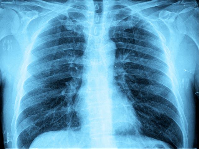 <p>A new report has warned of inequality in pneumonia care between parts of England</p>