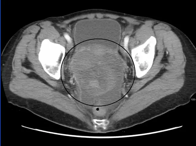 <p>A large ovarian cancer tumour as seen on a CT scan</p>